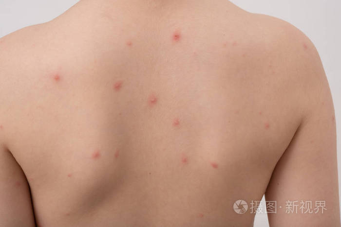 水痘病毒或水痘男孩背部特写 孩子身上有水泡疹 照片 正版商用图片2j0wj0 摄图新视界 水痘病毒或水痘男孩背部特写 孩子身上有水泡疹 照片 正版商用图片2j0wj0 摄图新视界