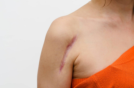 白色背景下孤立的拳头手部骨折一名股骨骨折的男子在安装钢板的手术后