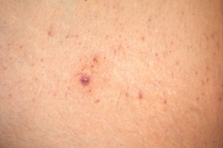 速度比赛汽车disseminate和recurentinfundibulofolliculitis播散性和