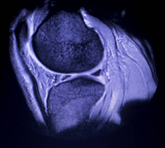 膝关节半月板撕裂扫描图片