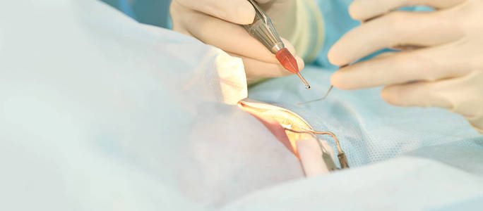 眼科激光显微镜手术.门诊医生.病人的眼睛治疗.