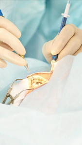 眼科激光显微镜手术.门诊医生.病人的眼睛治疗.