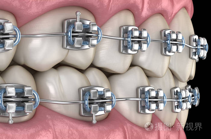 三维 排列 牙龈 凹痕 陶瓷 插图 医学 提供 牙医 支撑