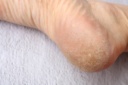 保健概念特写图片脚跟上有白色老茧.用于医疗目的的图像.照片