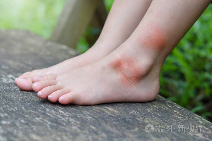 小女孩在游乐场公园玩耍时腿上蚊虫叮咬引起的过敏皮肤