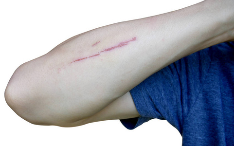 在白色背景下,男人手臂周围的皮肤上有伤口摄影图