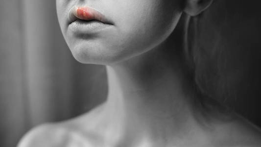 漂唇结痂年轻女子上唇疱疹照片