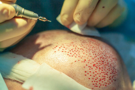 手术室的外科医生进行毛发移植手术.