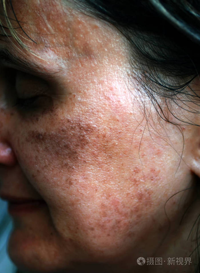 脸上有色素斑脸颊色素沉着