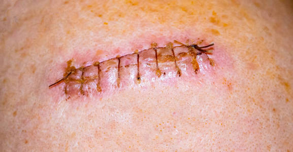 老婆结扎后的刀疤图片图片