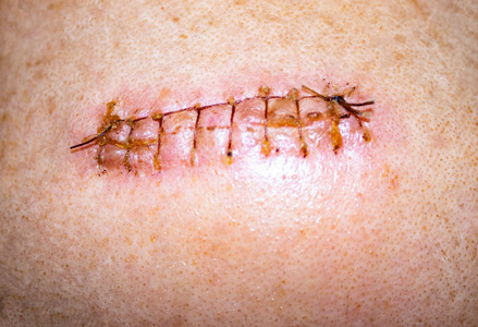 从手术疤痕手术留下的疤痕.照片