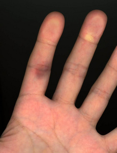 手指毛细血管破裂照片