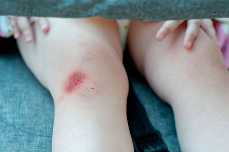 新鲜的伤口图片-新鲜的伤口素材-新鲜的伤口插画-摄图新视界