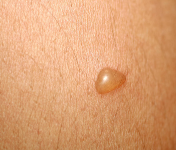 起水泡皮肤烧伤.皮肤起水泡照片