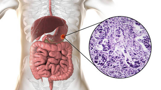 胃腺癌图片图片