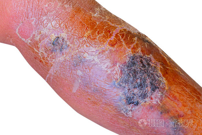 白底老年人皮肤下丹毒细菌感染