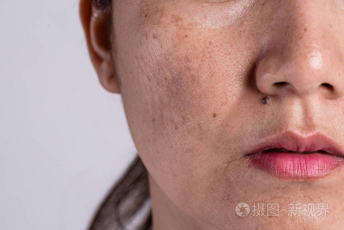 有问题皮肤和痤疮疤痕的女人 问题护肤与健康概念 皱纹 黄褐斑 黑斑 雀斑 皮肤干燥和面部色素沉着 照片 正版商用图片2loa4l 摄图新视界