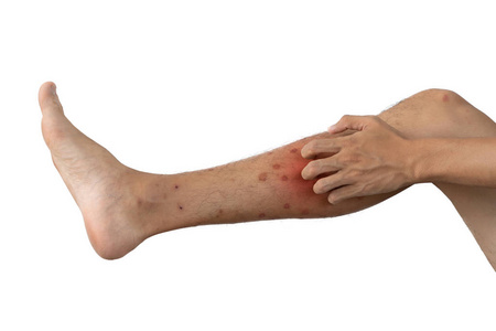 对昆虫蚊子或虫子b过敏的男人腿的特写镜头照片