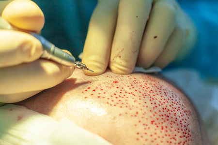 脱发治疗.头发移植.手术室的外科医生进行毛发移植手术.