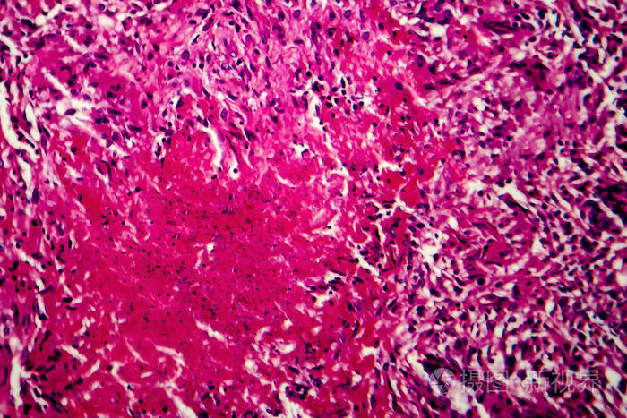 粟粒性肺结核光镜