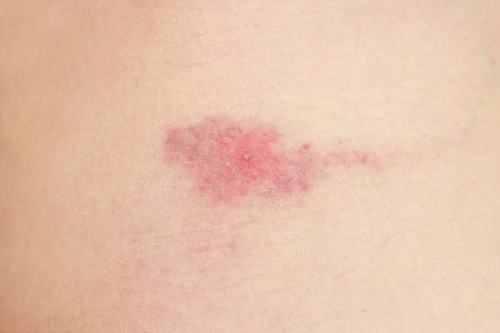 一天后咬伤部位出现红斑照片