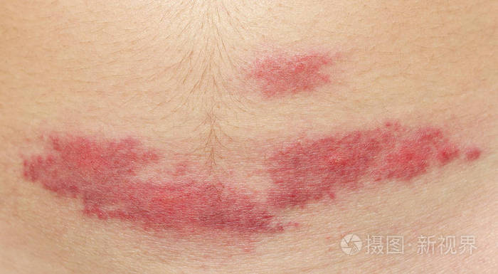 一天后咬伤部位出现红斑