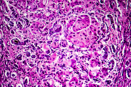 组织病理学胆汁性肝硬化的组织病理学照片