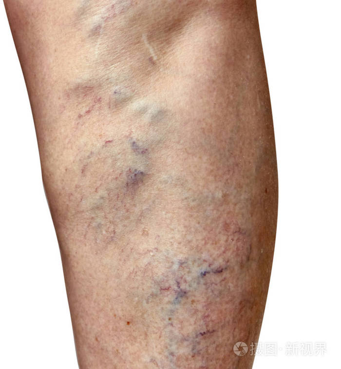 女性腿部静脉曲张静脉学