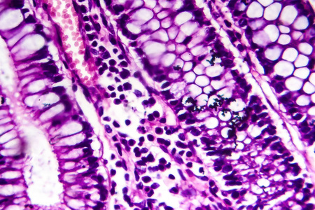 细菌性痢疾,显微照片人类的脑星形细胞瘤胃腺癌,胃癌,插图和光镜脂肪