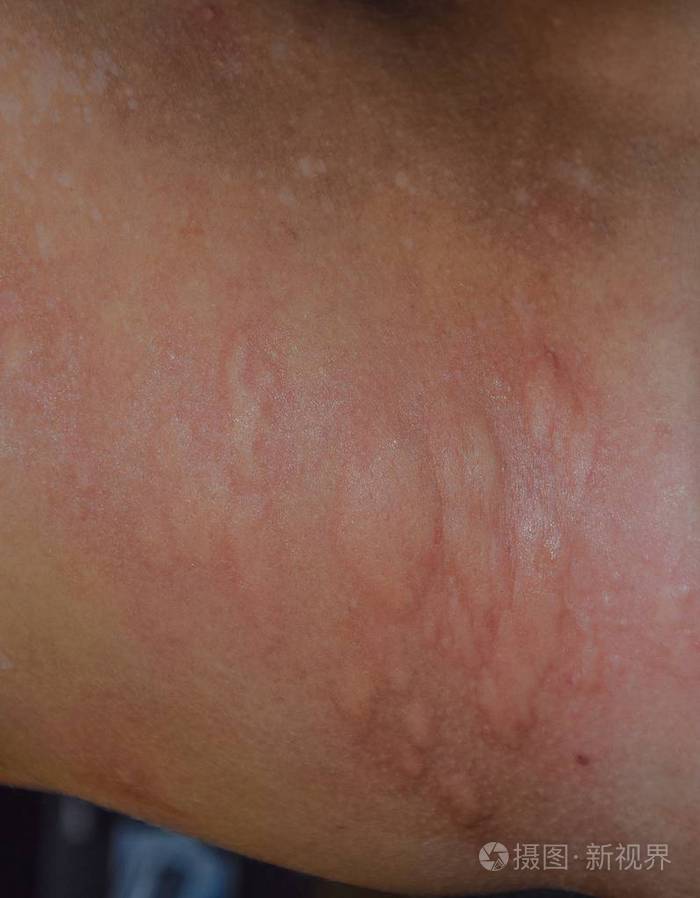 背部和两侧皮肤过敏皮肤上的过敏反应表现为肿胀和发红