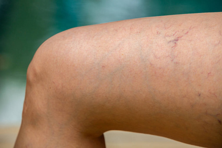 女性大腿和腿部静脉曲张,模糊的蓝色游泳池背景,特写和宏观拍摄,选择