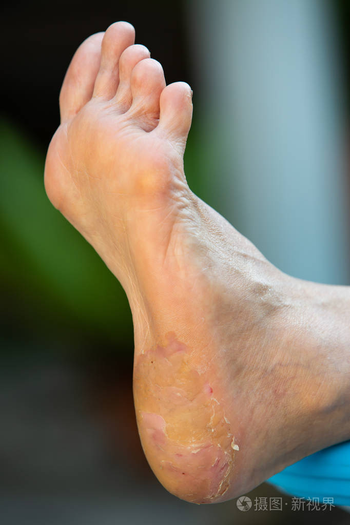 老年妇女足跟骨折脱皮足部皮炎闭合性