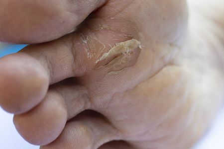 人体足部女性足部骨折及脱皮,足部苍蝇性皮炎,白色背景,特写和宏观