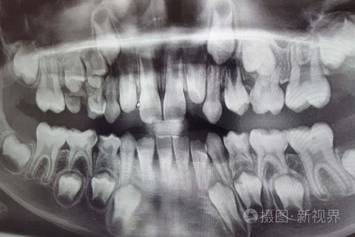 小孩牙齿x光图图片