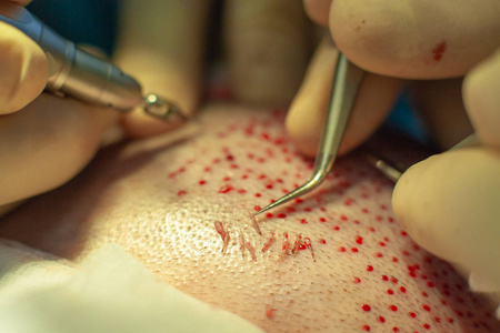 头发移植.手术室的外科医生进行毛发移植手术.