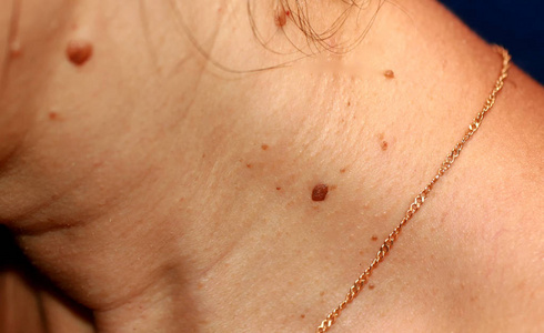 脖子上有痣.脖子上的胎记.照片
