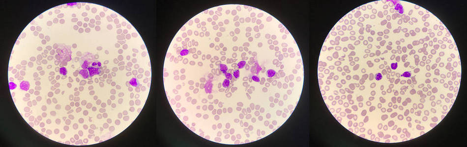 白血病细胞图片