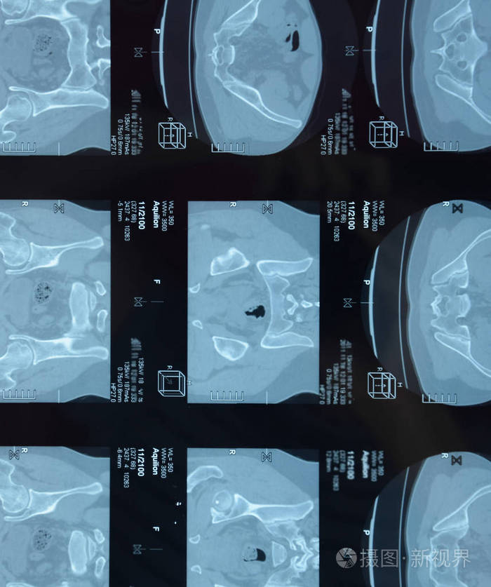 骶髂关节磁共振成像强直性脊柱炎的研究