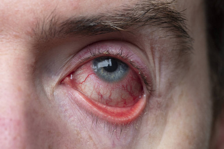 眼睛充血严重充血的眼睛的特写镜头.眼睑炎,结膜炎照片