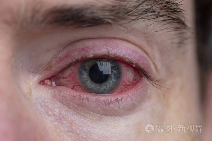 严重充血的眼睛的特写镜头眼睑炎结膜炎