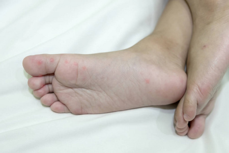 婴儿右脚过敏性皮疹照片