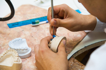 牙医用石膏铸成一种牙种植修复体照片