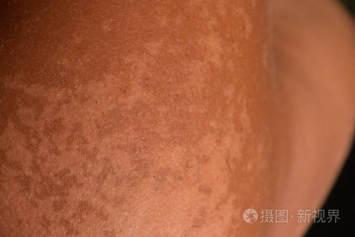 肩部皮肤晒伤去角质皮肤脱落危险的晒黑