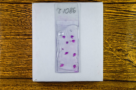 癌显示her-2表达肝脂肪变性显微镜载玻片肝癌发生的人权人类的肝的