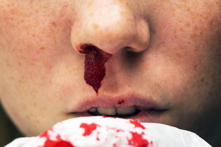 流鼻血是什么原因男生图片