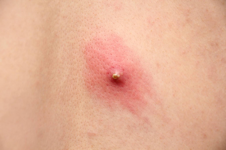 流行的粉刺人体皮肤上的大面积发炎丘疹,医学概念,特写,复制空间照片