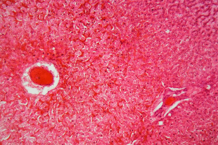 显微镜下的肝细胞显微镜下肝组织淀粉样变性.