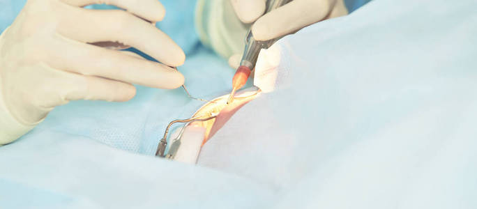 眼科激光显微镜手术.门诊医生.病人的眼睛治疗.