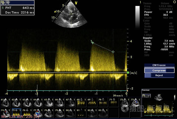 超声心动图超声机屏幕。
