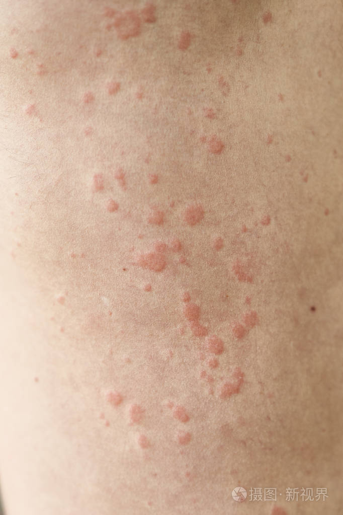 荨麻疹病.皮肤上的红点.照片-正版商用图片2ockml-摄图新视界